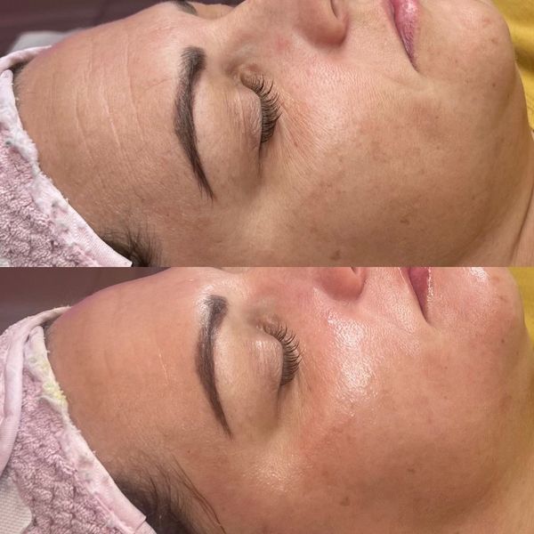 Before and after BioRePeel