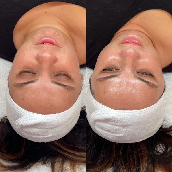 Before and after facial treatment showing improved skin glow and clarity.