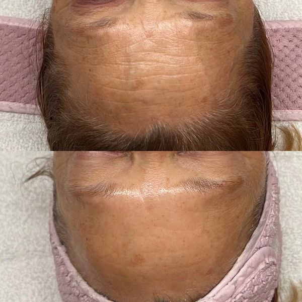 Before and after skincare treatment showing reduced forehead wrinkles and smoother skin.