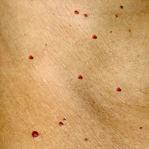 Cherry Angioma Removal 
