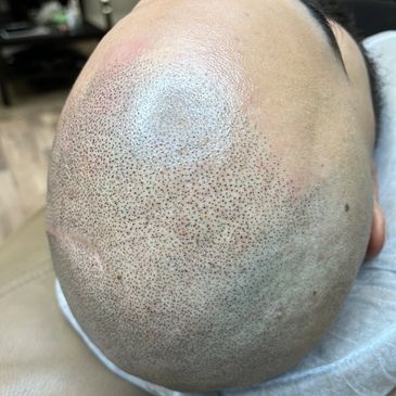 SMP | Scalp Micropigmentation