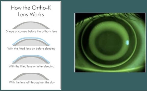 Diagrams of corneal shape changes from ortho-k lenses beside a corneal topography image