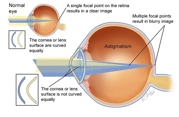 Diagram of an eye illustrating astigmatism and focal points on the retina