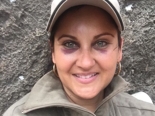 A close up of Cara’s smiling face showing the bump on her forehead and two purple black eyes. 
