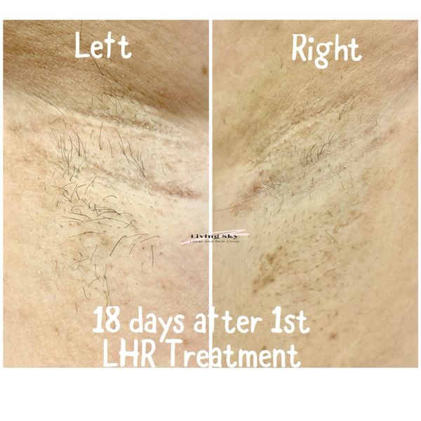 Underarm laser hair removal