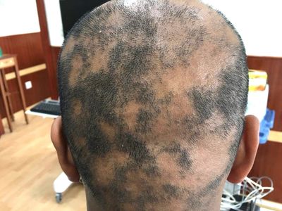 Alopecia Areata