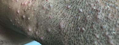 Acne vulgaris