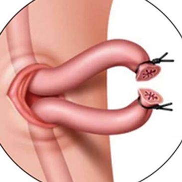 Vasectomía - Vasectomía sin bisturí