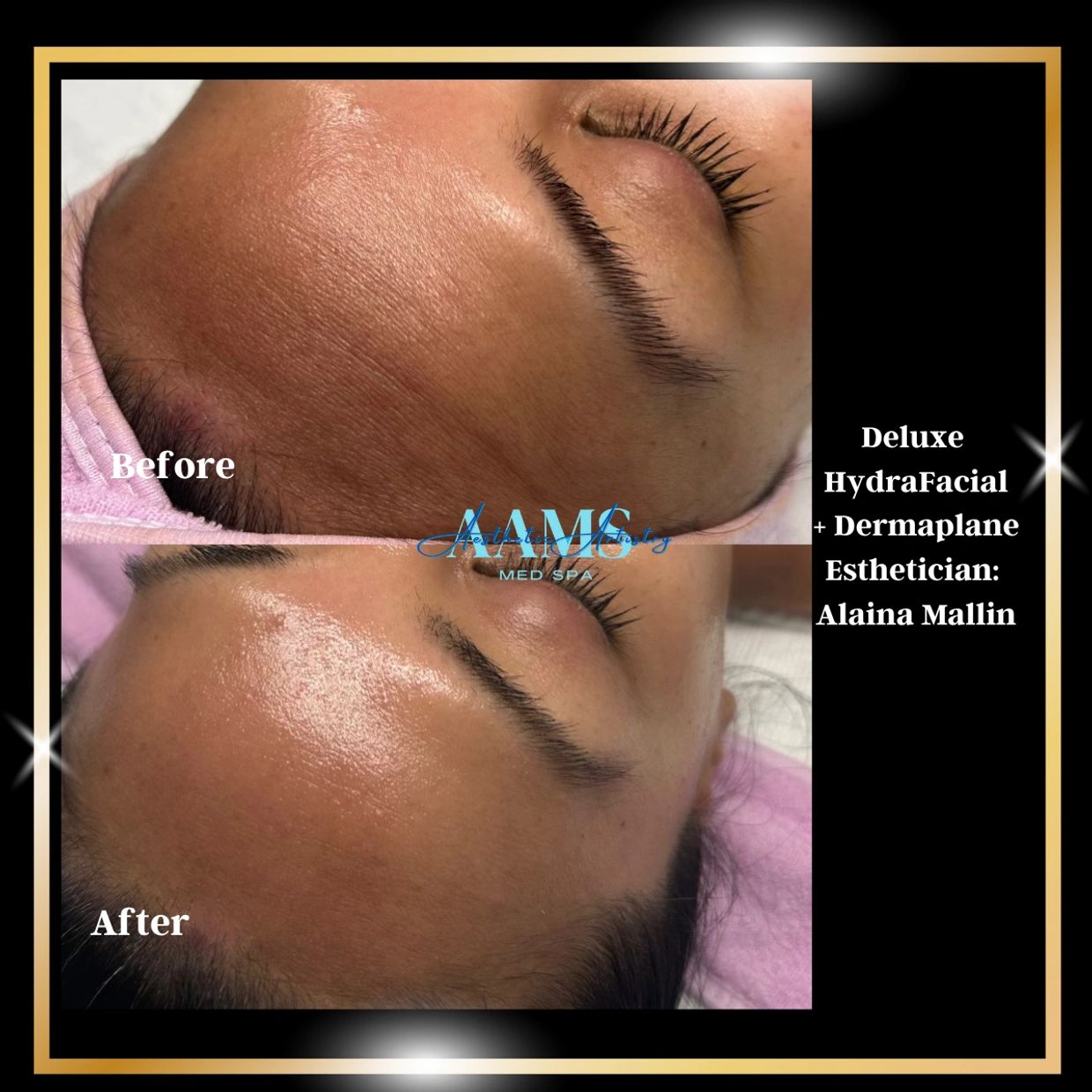 Deluxe Hydrafacial