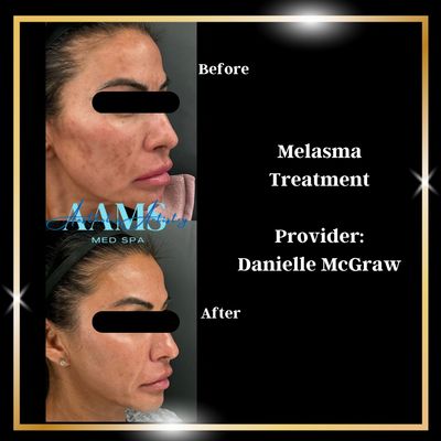 Melasma and acne scar treatment before and after