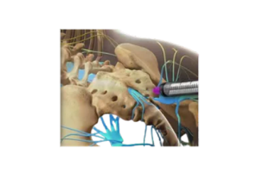 bpc 157 lyme What Is Spinal Stenosis with IBJI's Craig Forsthoefel, MD main image 0
