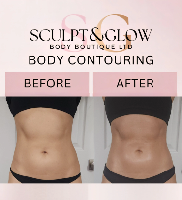 Before and after photos showing body contouring results from Sculpt &amp; Glow.
