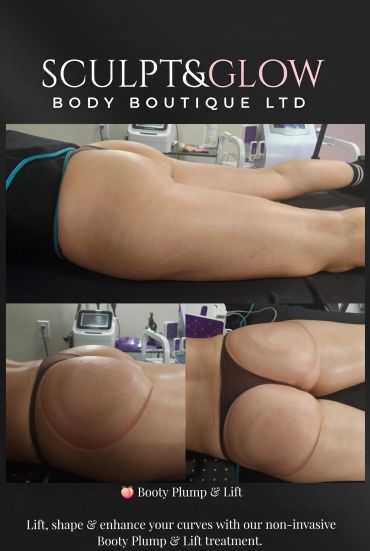Non-invasive booty plump and lift treatment results.