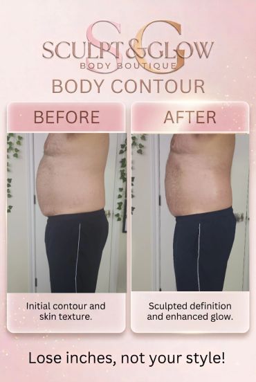 Before and after body contour results showing a slimmer waist.