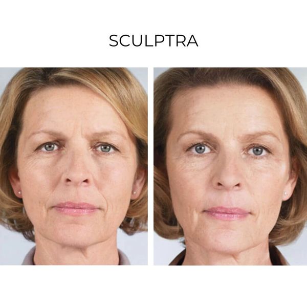 Before and after Sculptra treatments