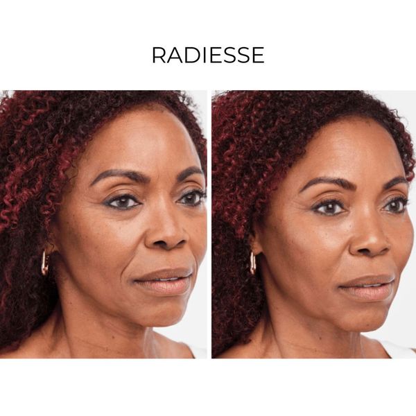 Before and after Radiesse treatments