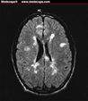 MRI od Multiple SClerosis