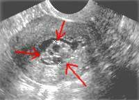 endometrial_hyperplasia and polyps on pelvic sonogram 
