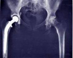 Hip Replacement Jeffrey Dach MD