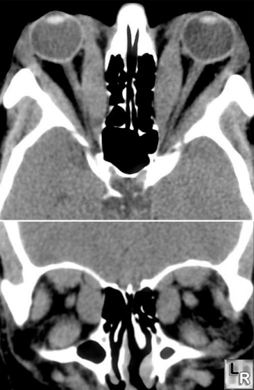 CAT_Scan_Orbital_Muscle_Hypertrophy_Graves