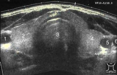 Ultrasound Image of Thyroid GLand