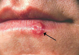 Herpes Simplex Labialis Lower Lip Natural Treatments Jeffrey Dach MD