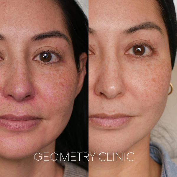 1 session of BBL HEROic- improvement in skin tone, redness, pigmentation