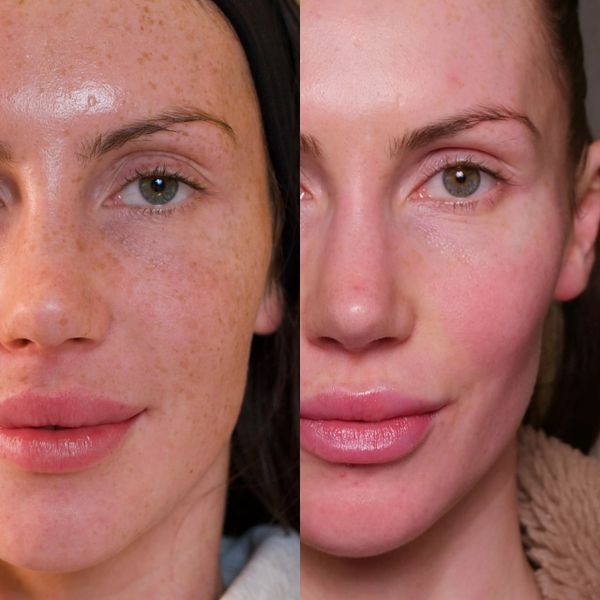 1 session of BBL HEROic - elimination of sundamage, freckles, improvement of the skin tone