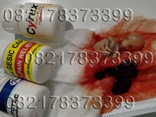 # Jual Obat Penggugur Kandungan Asli: Cara Aborsi Kehamilan/Janin Usia Janin 1 Sampai 8 Bulan/Minggu