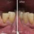 Before and after teeth