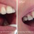 Before and after teeth