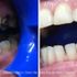 Before and after teeth