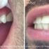 Before and after teeth