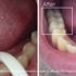 Before and after teeth