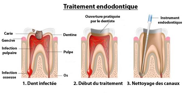 Dent Infectée : traitement de canal ou extraction dentaire ?