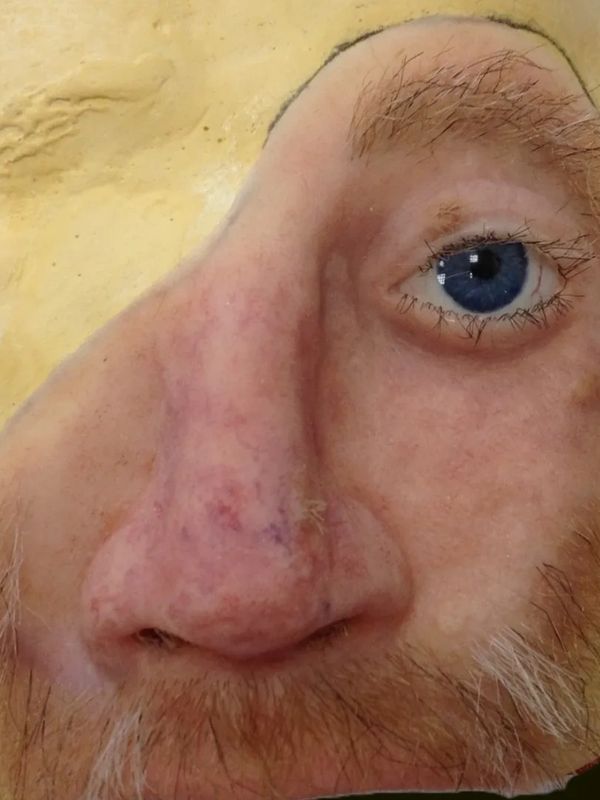 Silicone facial prosthesis / custom-made facial prosthesis / artificial eyes