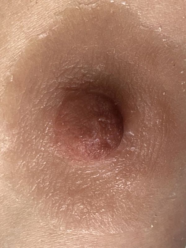 prosthetic nipples uk / nipple prosthesis uk