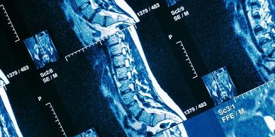 xrays showing tumors of the spinal cord