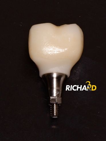 Tibase para Coroa sobre Implante Cone Morse