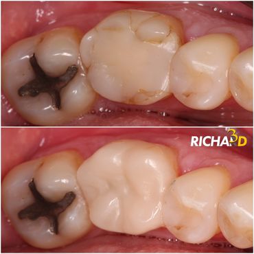 Onlay fresada em Resina Híbrida (Resina + Zircônia