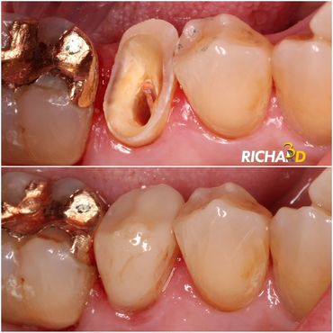 Endo-Crown em Resina