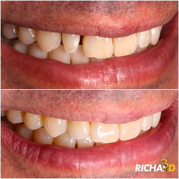 Faceta em Disslicato de Lítio - Correção de Dente Conoide