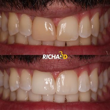 Facetas em Porcelana