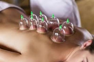 Cupping Therapy example image.