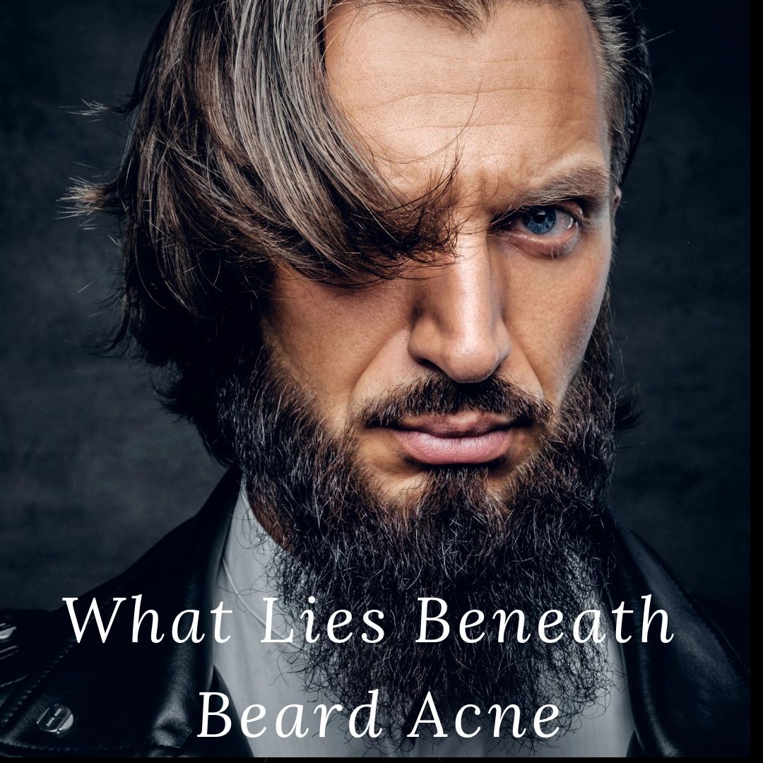 What Lies Beneath Beard Acne