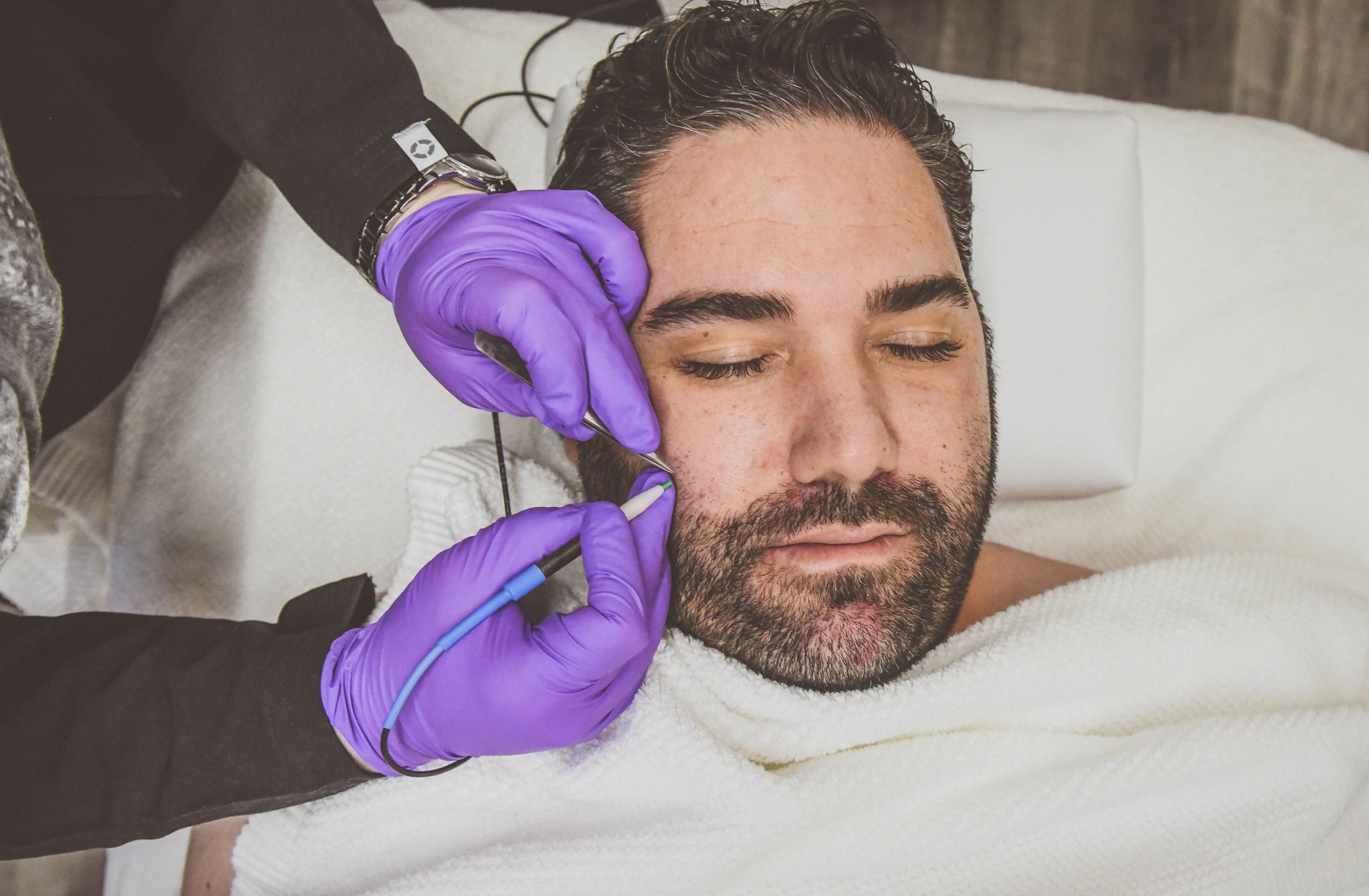 Are There Any Side Effects From Electrolysis Treatments?