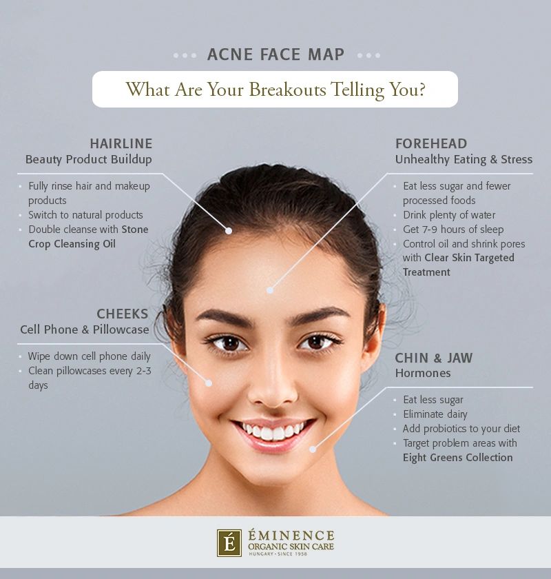 acne-breakout-here-s-what-you-need-to-know-acne-aid-solution