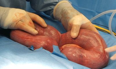 Canine c-section surgery showing gravid uterus.