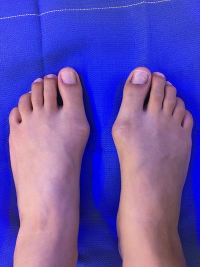 Deformidad hallux valgus (juanete) ambos pies.
Problema ortopédico como causa frecuente de dolor.