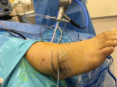 Reparación Artroscópica de ligamentos de tobillo por "esguince crónico", rápida recuperación.